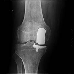 Kniegelenksersatz - Schlitten