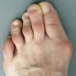 Hallux valgus