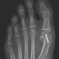 Hallux valgus